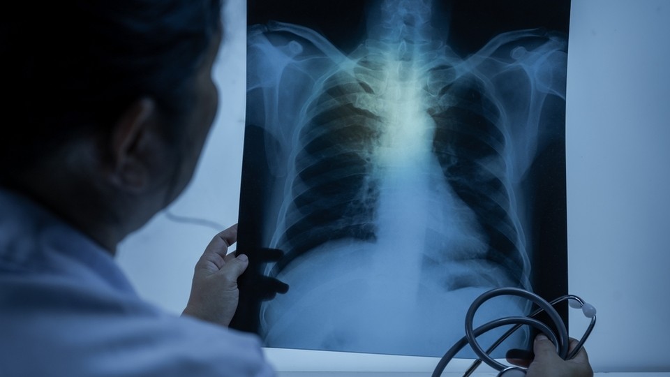 Akciğer kanserinde çevresel faktörlerin etkisi artıyor